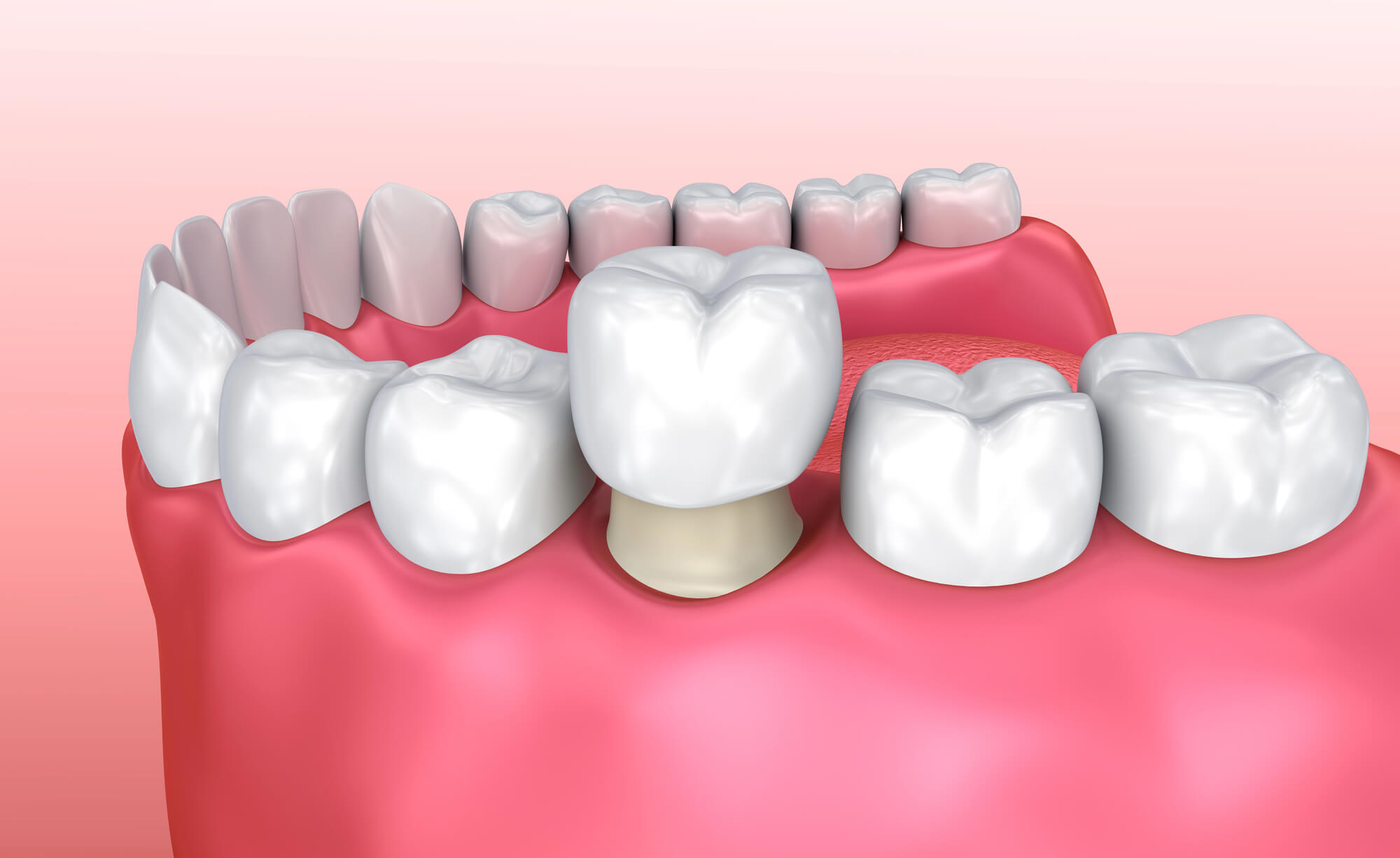 dental-crowns-concord-illustration