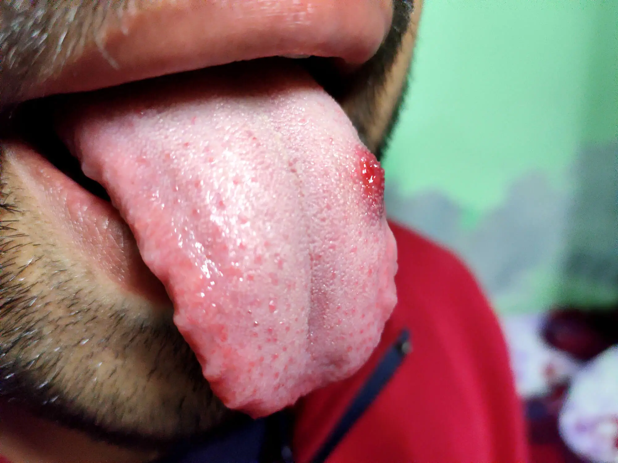 Dentist in Concord Explains Signs of Oral Cancer