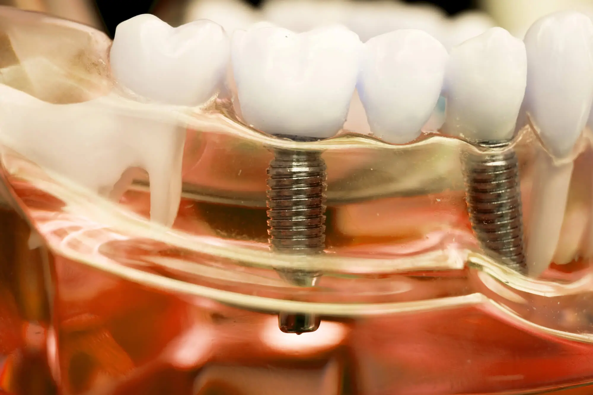 Dental Implants in Concord