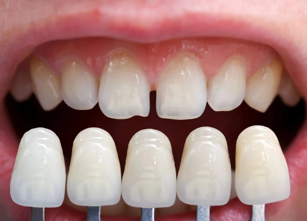 Cosmetic-Dentistry-in-Concord-Explains-What-Causes-Veneers-to-Fall